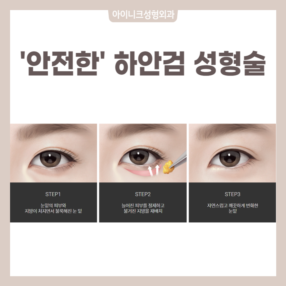 How Can You Get Recommended Midlife Eye Surgery Naturally Without Side Effects? image 4