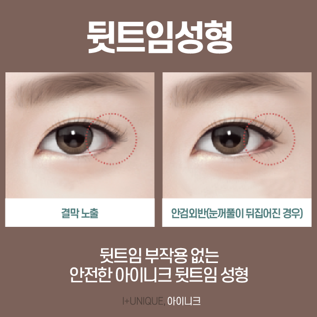 뒤트임성형 이제 더 이상 고민하지 마세요! 관련 이미지 3