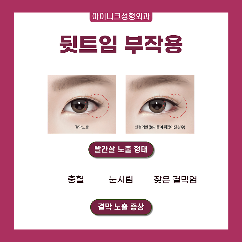 압구정 트임 수술 1위! 자연스럽고 확실한 인상 변화 관련 이미지 5