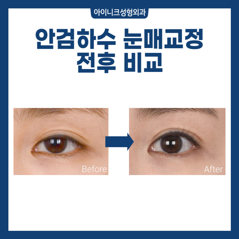 눈매교정수술전후, 또렷한 차이! 관련 이미지 5