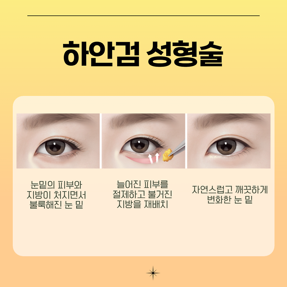 눈처짐수술 후기가 증명하는 아이니크 관련 이미지 4