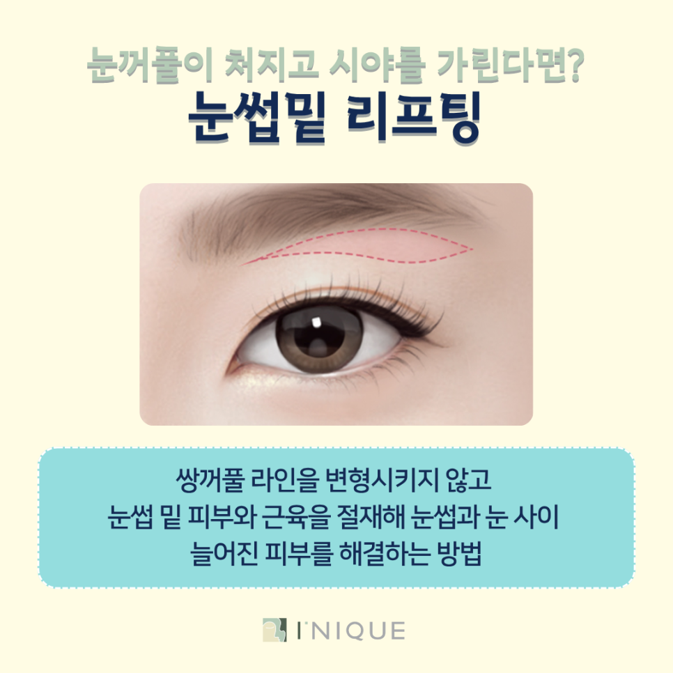 Mature Eye Reoperation Plastic Surgery: High Satisfaction from the First Surgery image 4