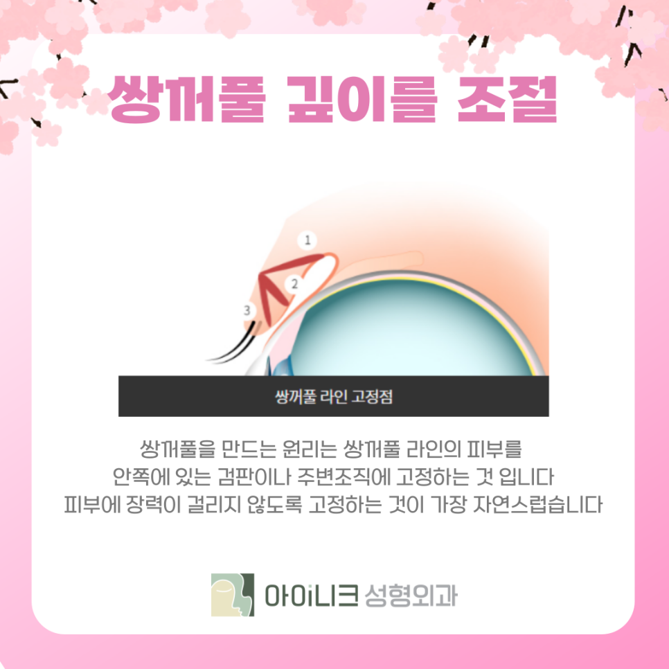 강남 쌍수 흉살 재수술이 필요한가요? 관련 이미지 7