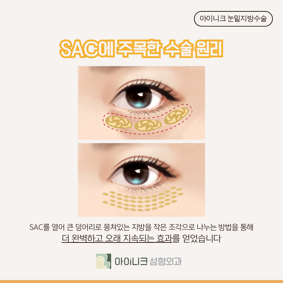 How Long Is the Recovery Period After Under-Eye Fat Repositioning Surgery at Sinsa Station? image 4