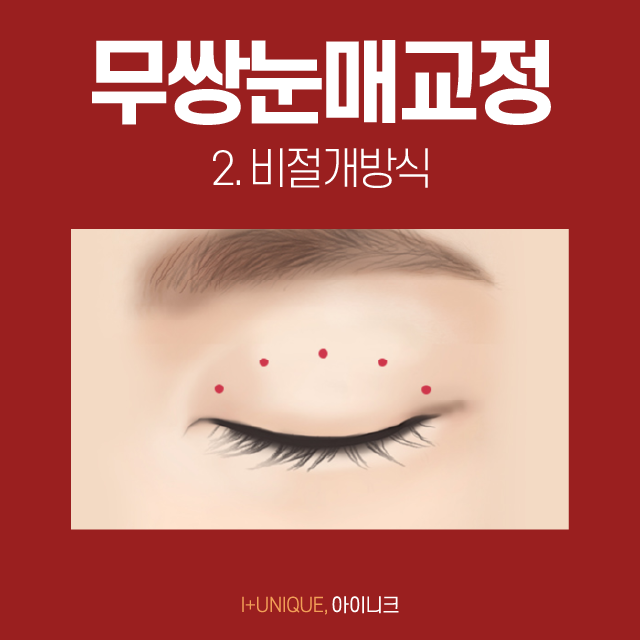 If You Want Natural, Clear Double Eyelids? Male Double-Eyelid Eye Correction Is the Answer! image 6