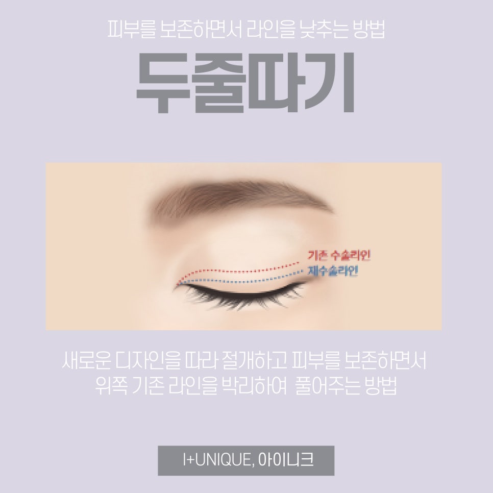 속상한 쌍꺼풀라인낮추기 아이니크성형외과에서 해결하자 관련 이미지 4