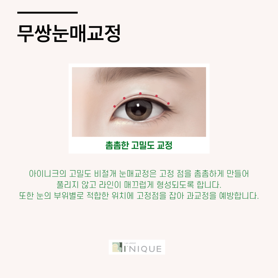 남자속쌍눈매교정 성공하는 법 관련 이미지 4