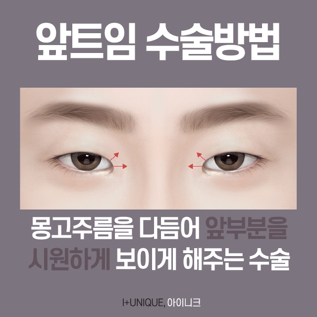 뒤밑트임 성형 성공하는 방법은? 관련 이미지 3