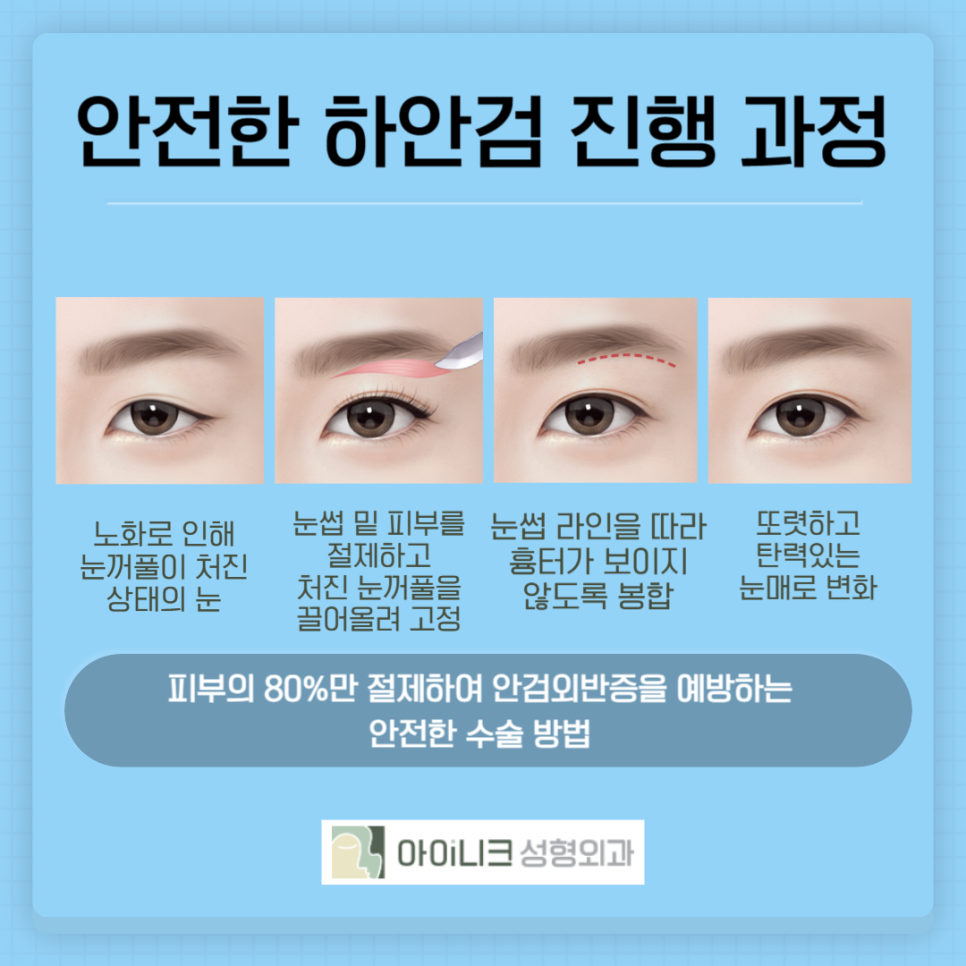 강남역 하안검 잘하는곳 관련 이미지 4