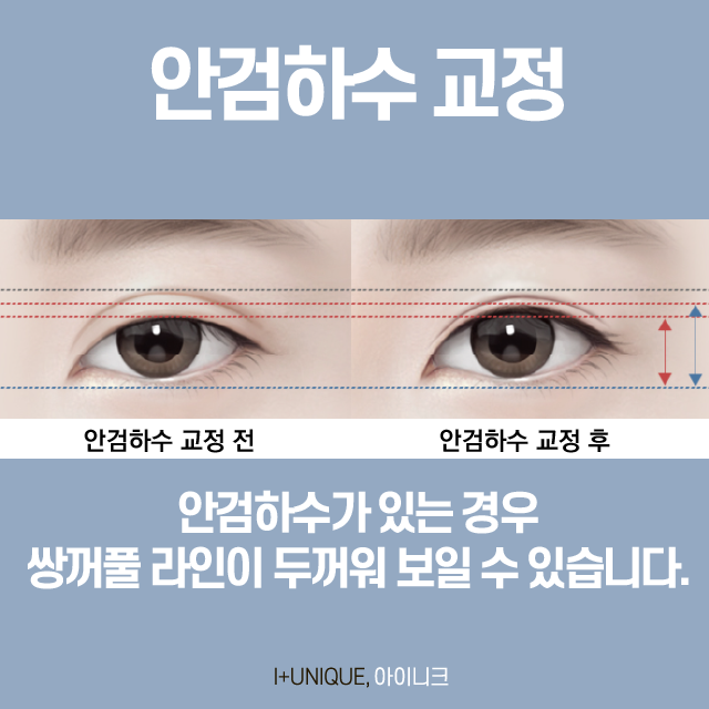 There Is No Second Failure! Proper Revision Eyelid Surgery image 4