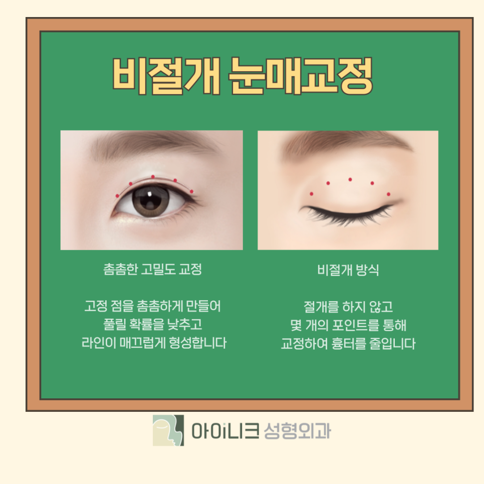 눈매교정수술로 눈 뜨는 힘 키워주기 관련 이미지 9