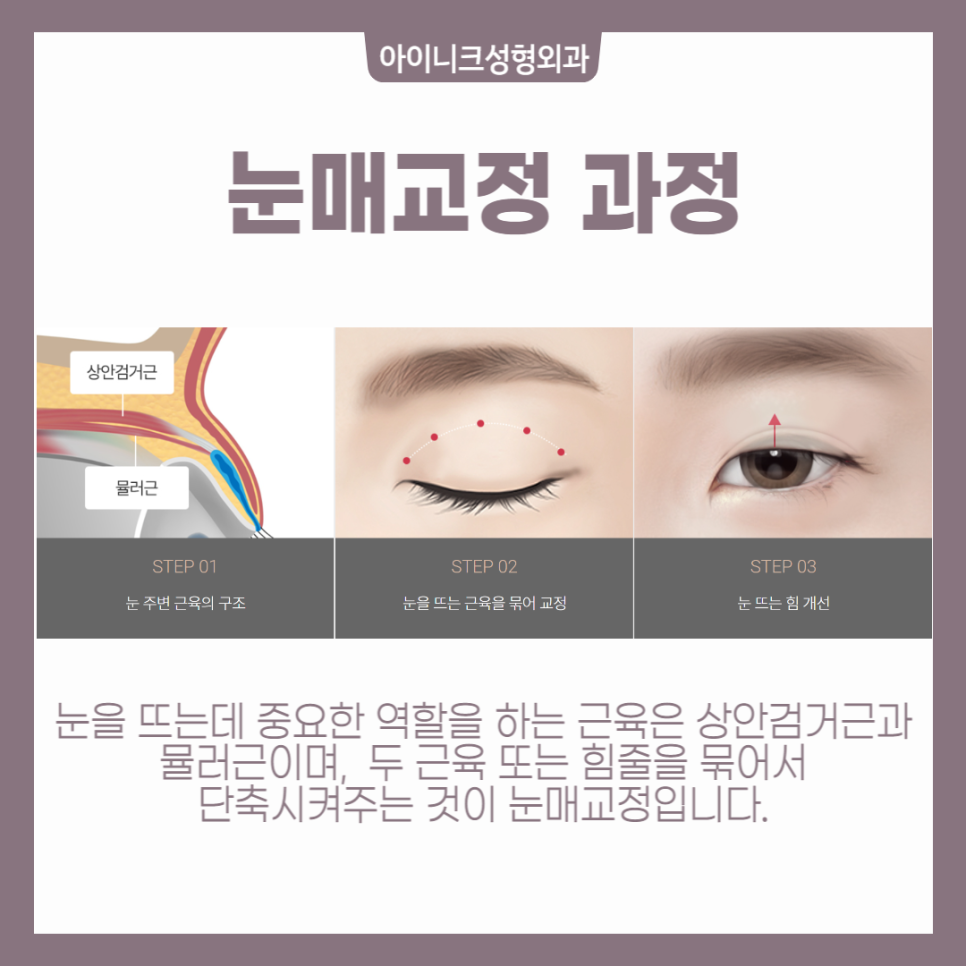 안검하수눈매교정 비절개 방식과 절개 방식 장단점과 추천 대상 관련 이미지 4