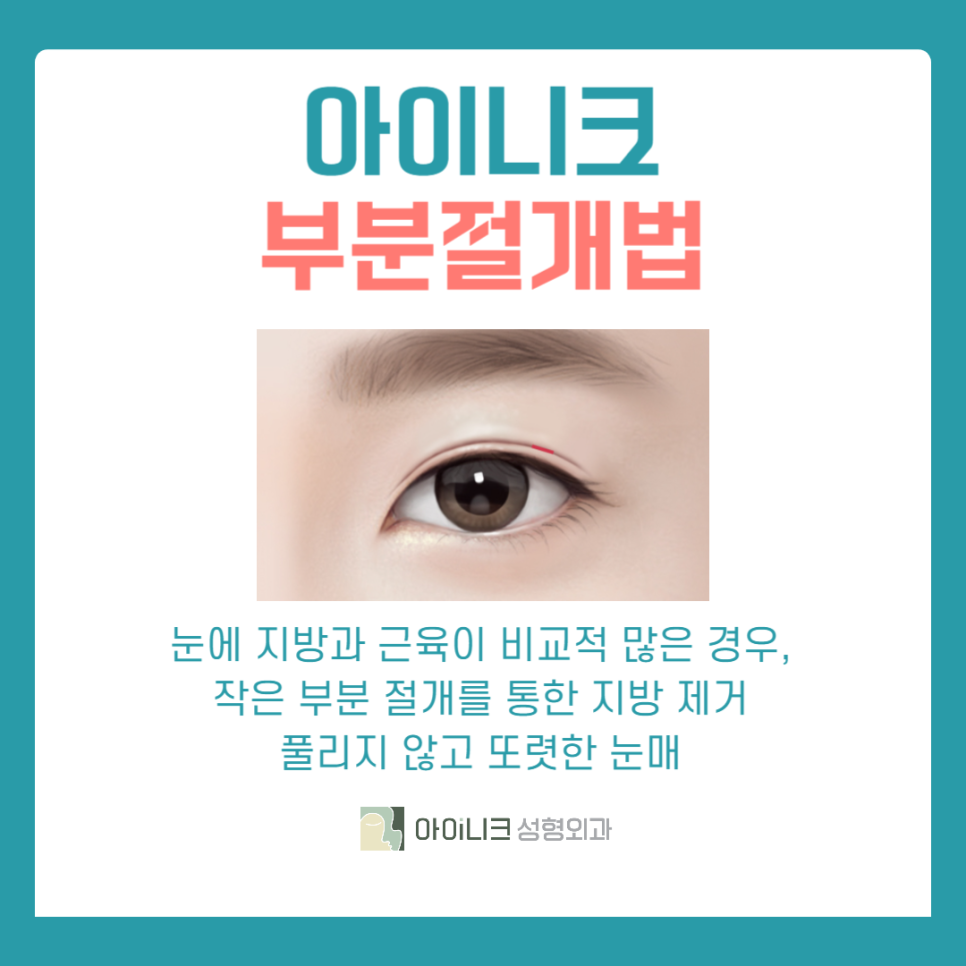 Recommended Eye Surgery for Men: If You Want Softer Eyes image 5
