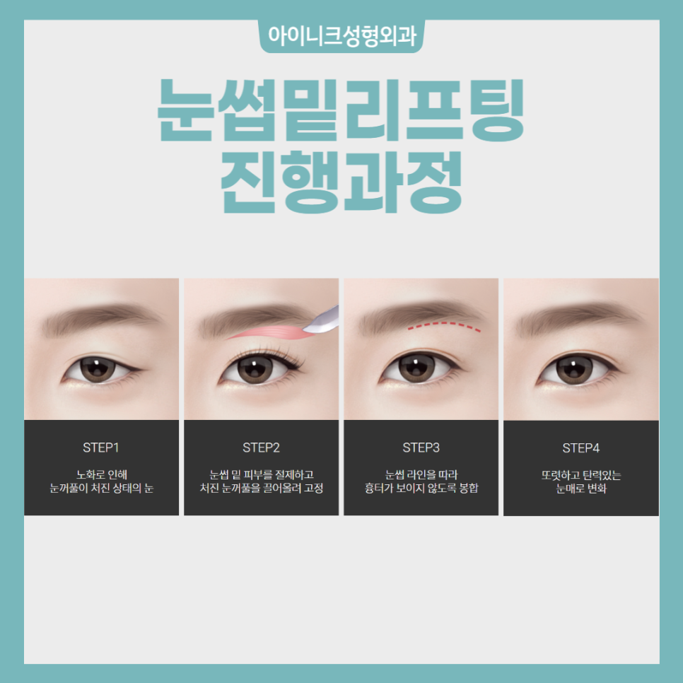 중년눈수술, 젊은 눈으로 되돌리고 싶다면? 관련 이미지 3