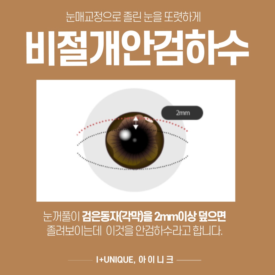 비절개안검하수 수술을 찾고 있다면 아이니크성형외과로 관련 이미지 2