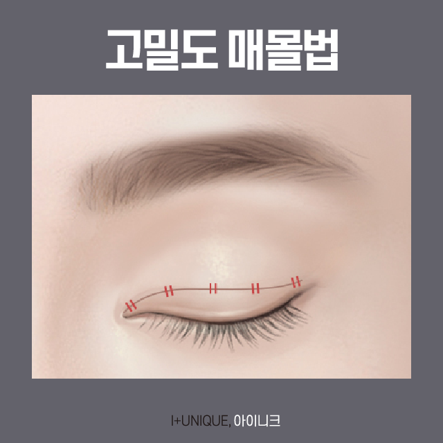 나에게 맞는 쌍꺼풀 수술이 궁금하다면? 관련 이미지 5