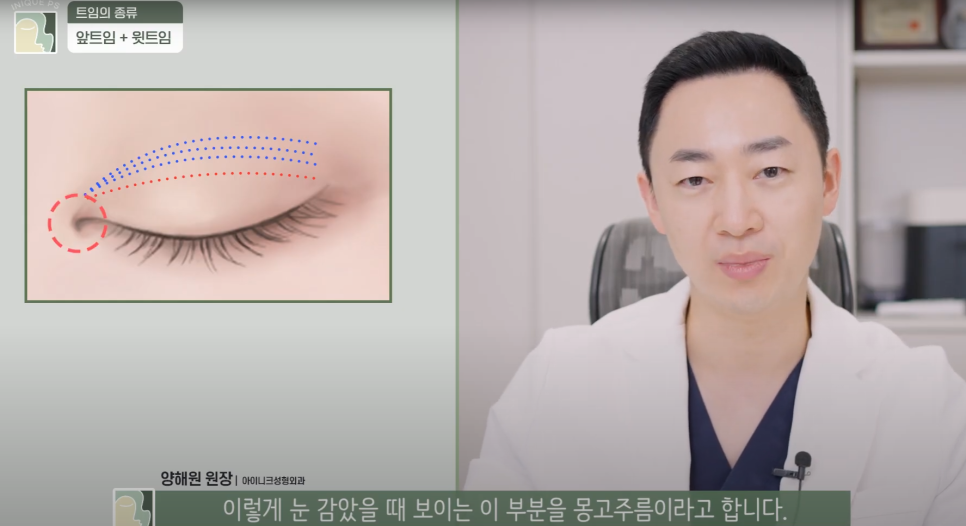 Upgraded with Apgujeong Eye Corner Surgery: Eyes That Look Twice as Large! image 3