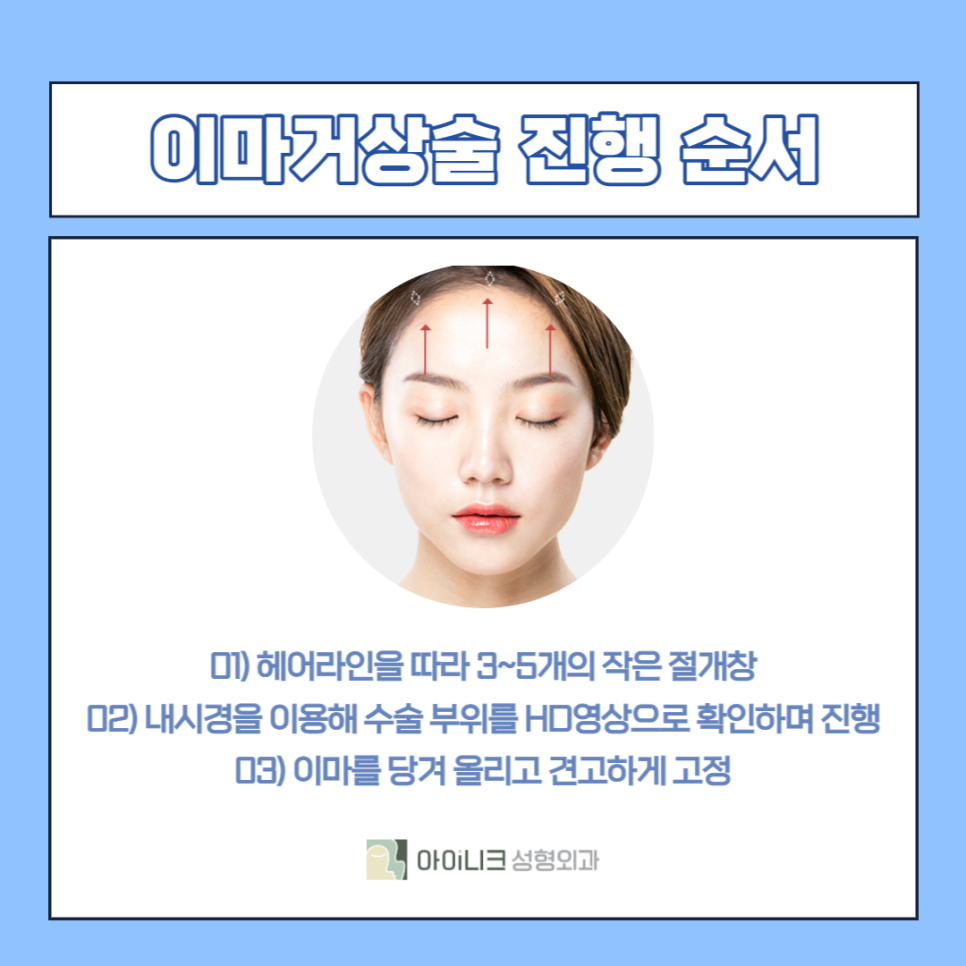안면거상술잘하는곳 찾는다면 주목하세요! 관련 이미지 4