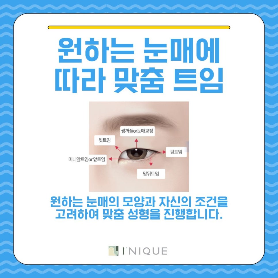 작은눈성형, 이게 답이다! 관련 이미지 4