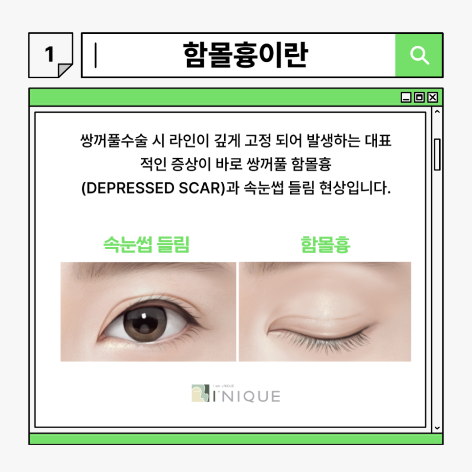눈성형재수술, 고민하고 있다면 관련 이미지 2