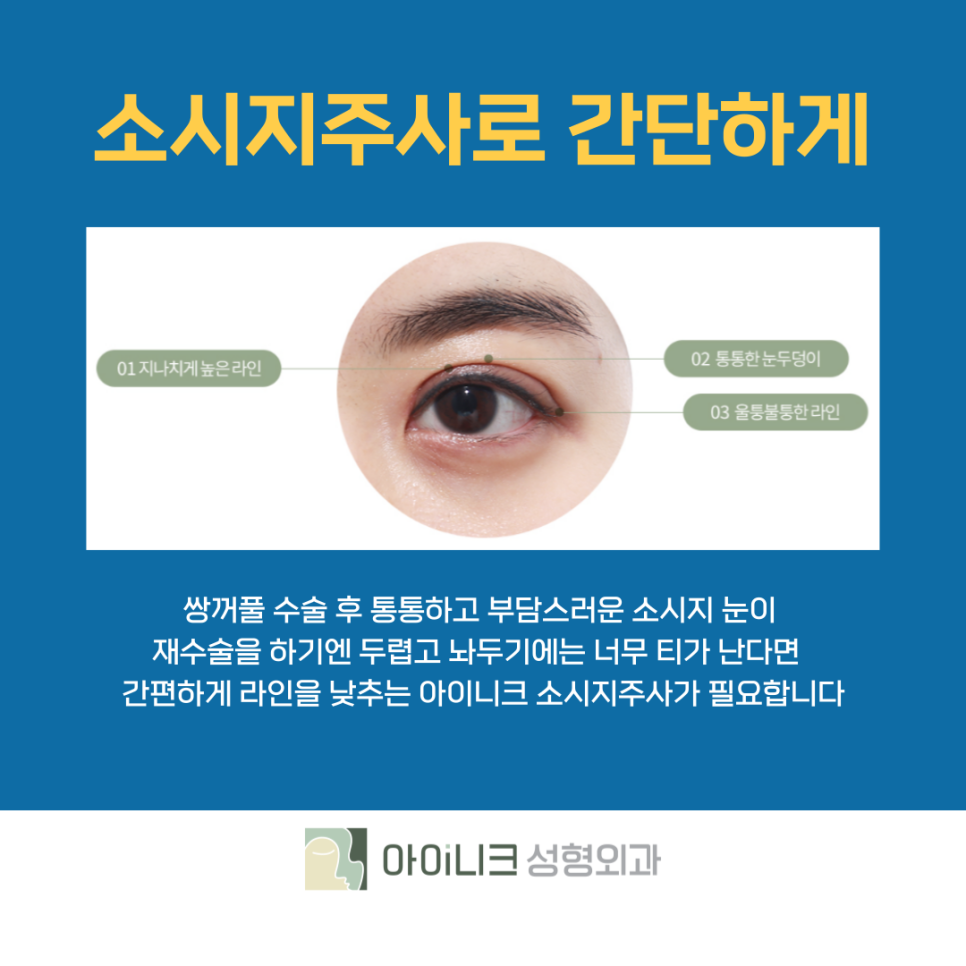 쌍수재수술비용 간편한 소시지 주사로 개선하기 관련 이미지 8