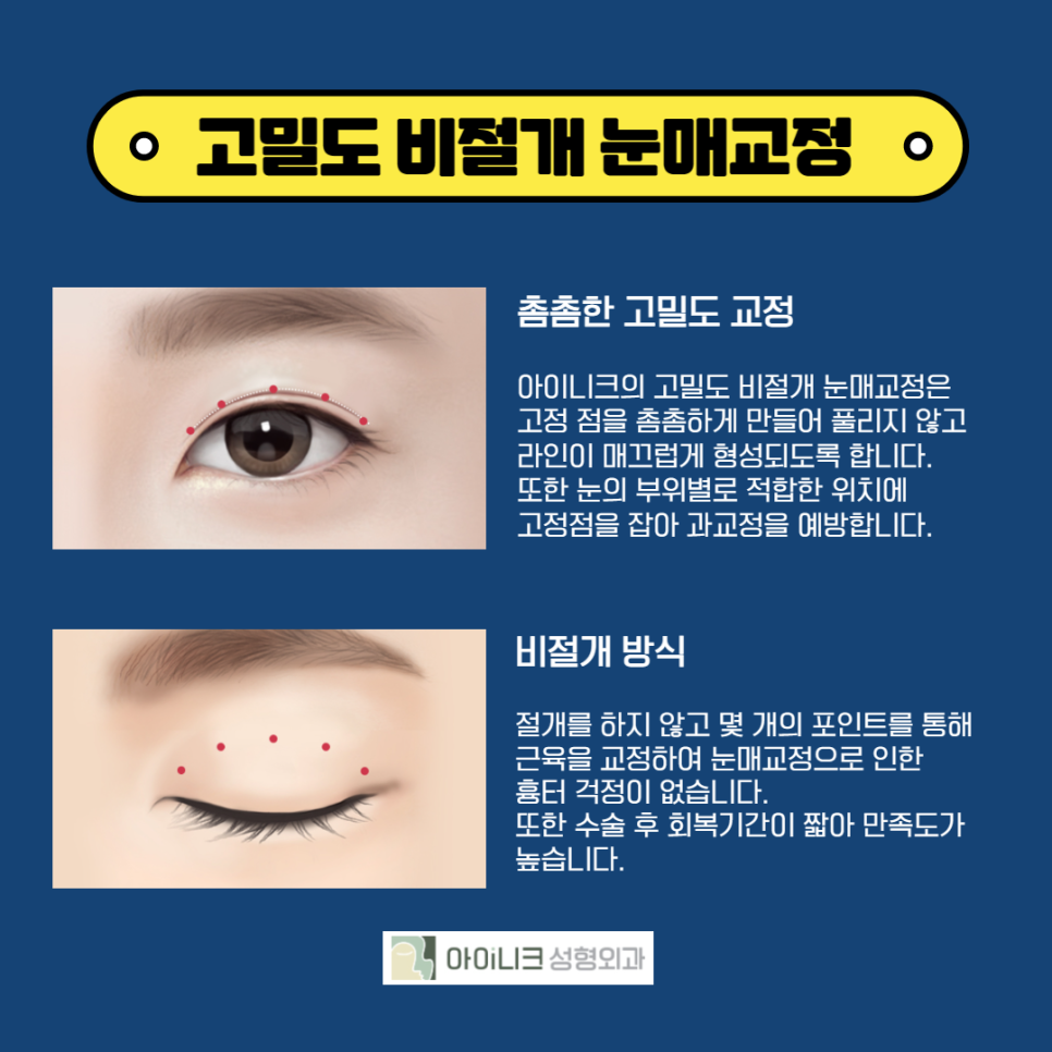 눈매교정잘하는곳에서 졸린 눈 해결 후기 관련 이미지 5
