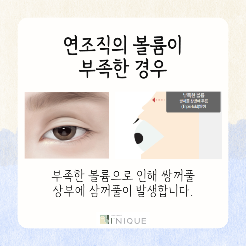 쌍꺼풀 겹주름 완벽하게 개선하는 법! 관련 이미지 5
