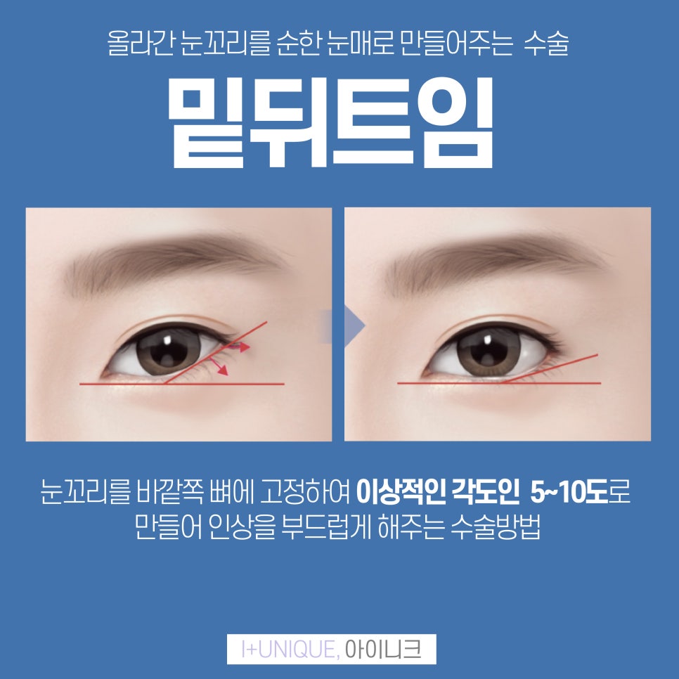 아이니크성형외과와 함께 트임종류 알아보자 관련 이미지 5