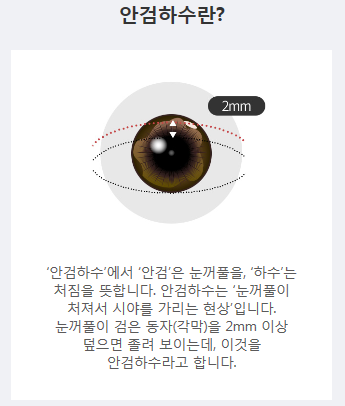 눈매교정술가격 좁은 시야를 개선하자! 관련 이미지 2