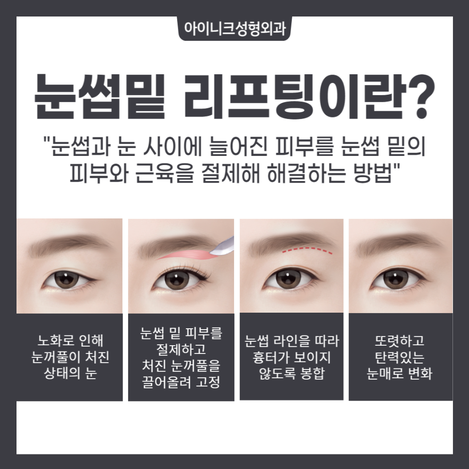 중년성형, 다시 20대의 눈매로 관련 이미지 2