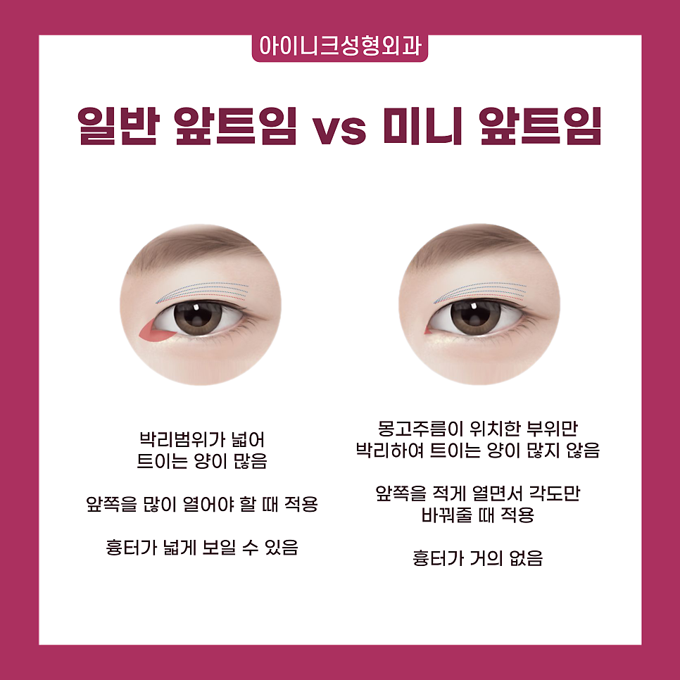 압구정 트임 수술 1위! 자연스럽고 확실한 인상 변화 관련 이미지 3