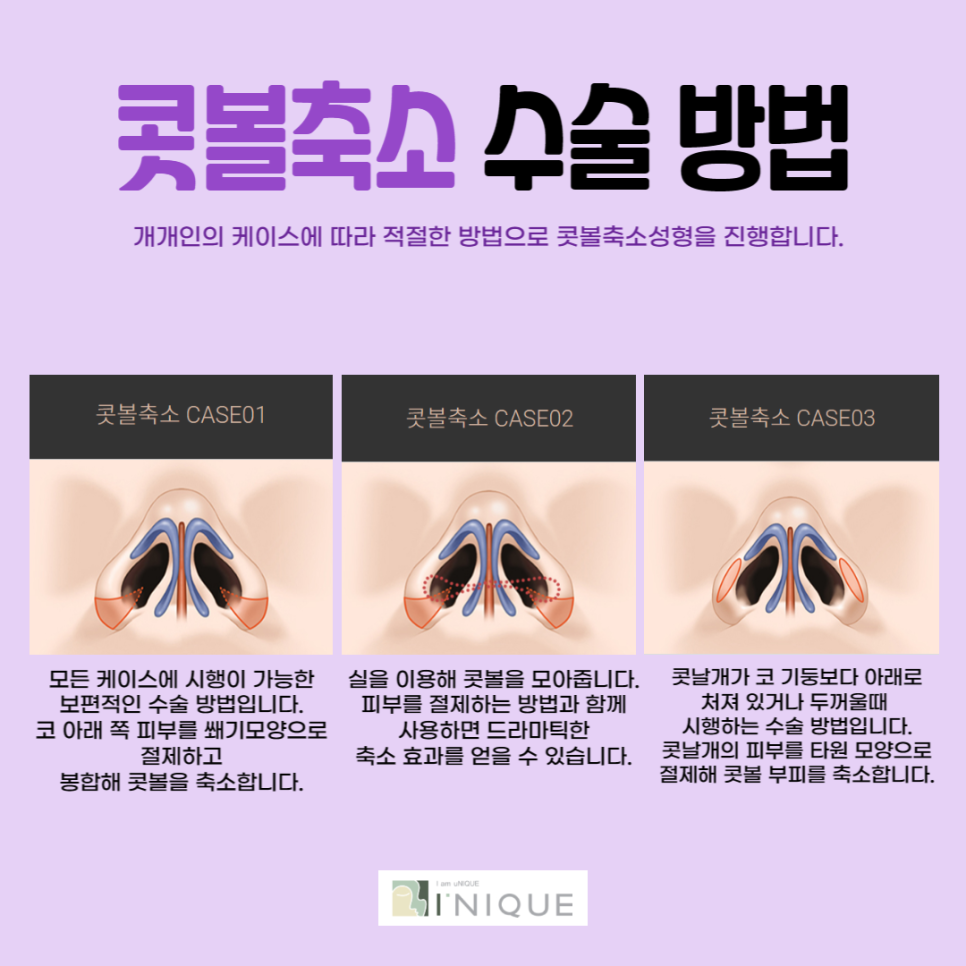 콧볼성형 하기 전 체크사항! 관련 이미지 5