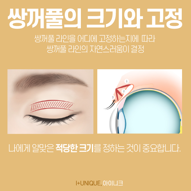 자연스러운쌍수를 원한다면, 병원부터 신중하게 골라야 관련 이미지 4