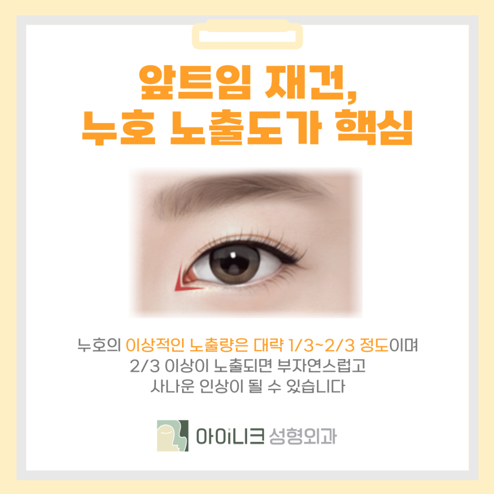 압구정 앞트임 재수술 꼼꼼함이 중요해요 관련 이미지 5
