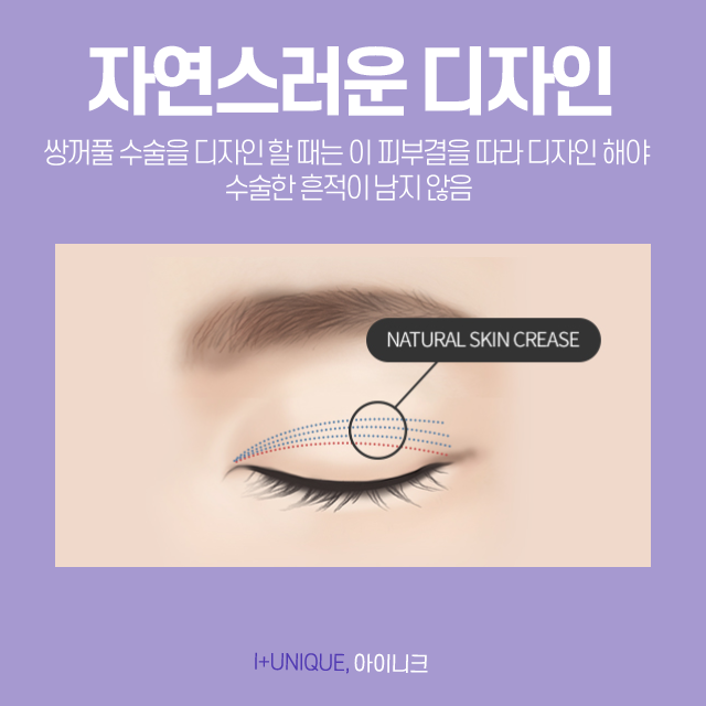 쌍꺼풀수술잘하는곳은 디테일함부터 다르다! 관련 이미지 5