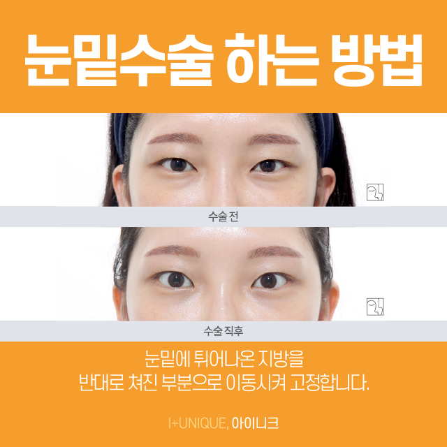 눈밑수술센터 수술 후 회복할 때 주의할점 관련 이미지 2