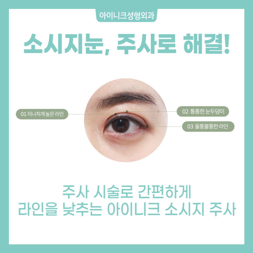 쌍꺼풀 붓기 도움을 원한다면? 관련 이미지 2