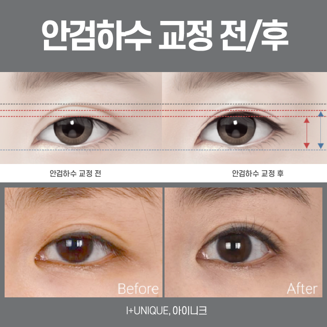 Sausage Double-Eyelid Correction: There Is No Second Failure! image 4