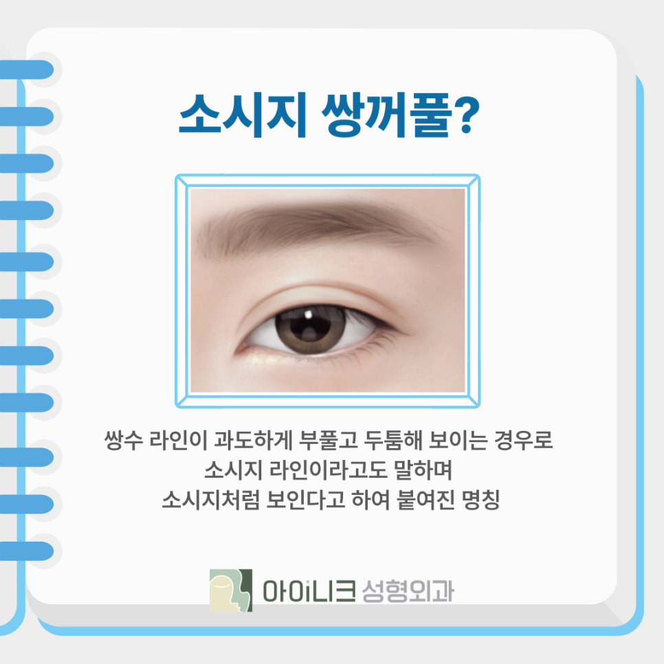 쌍꺼풀재수술비용과 함께 꼼꼼하게 따져야 할 것 관련 이미지 4