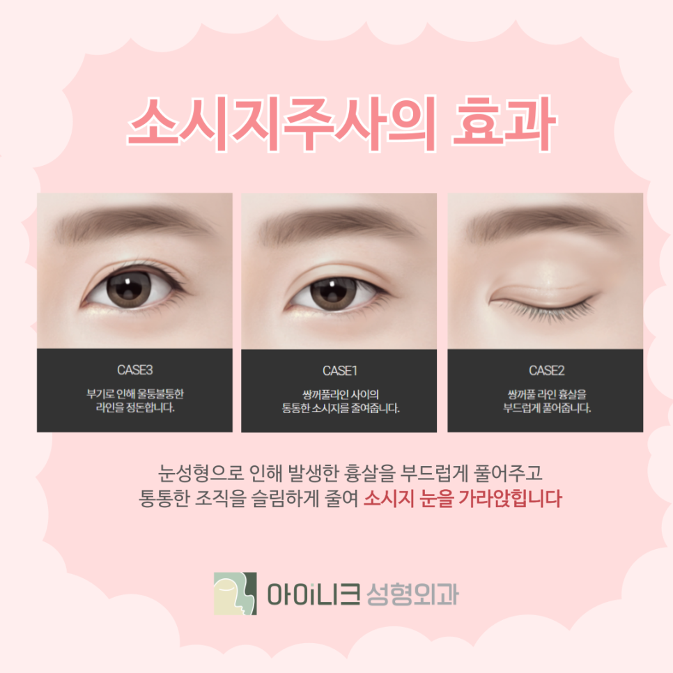 How to Reduce Double Eyelid Surgery Swelling and the Sausage Injection image 7