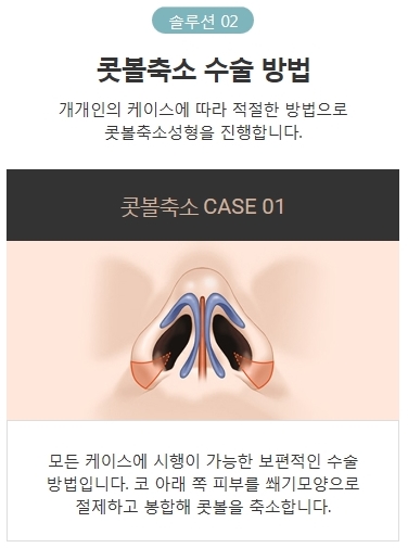 콧볼지방제거 세련된 이미지로 변신 관련 이미지 4