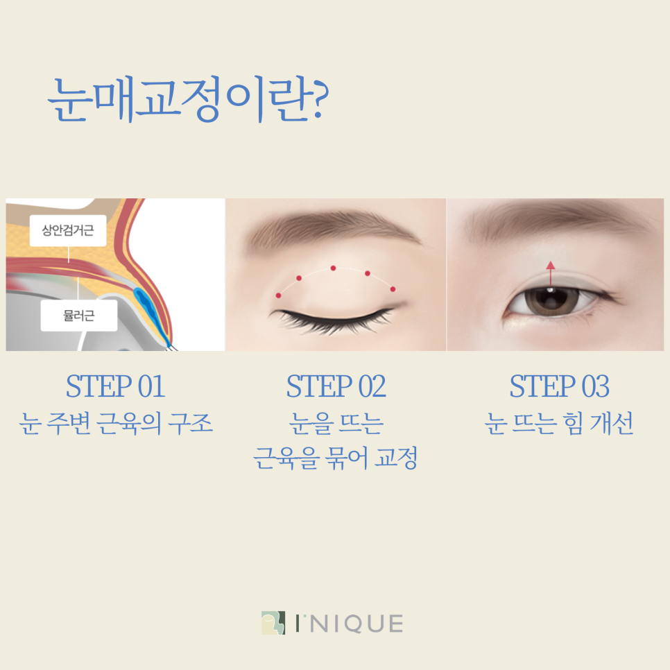 안검하수잘하는곳 관리까지 확실하게 관련 이미지 5