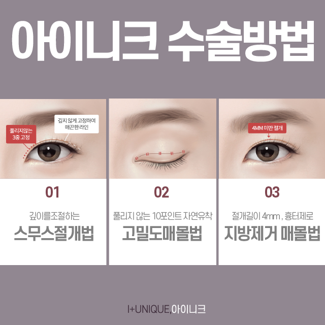 여자눈성형종류 나에게 맞는 방법은? 관련 이미지 2