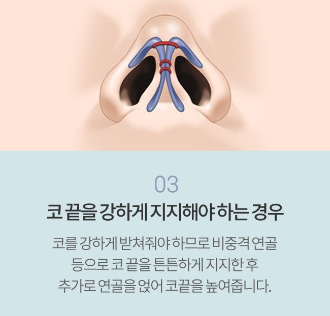 비개방코끝성형으로 처음부터 예뻤던 것처럼 관련 이미지 5