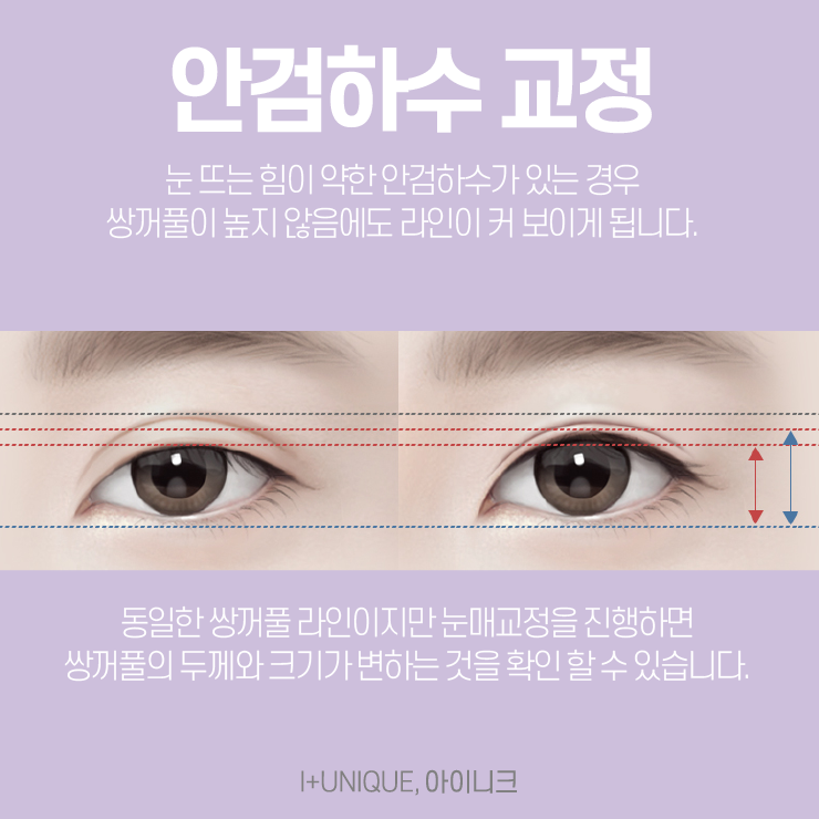 쌍꺼풀재수술잘하는병원, 아이니크성형외과 관련 이미지 4