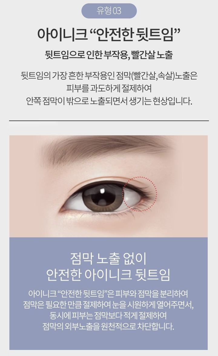 듀얼트임가격 맞춤 성형이 중요해~ 관련 이미지 6