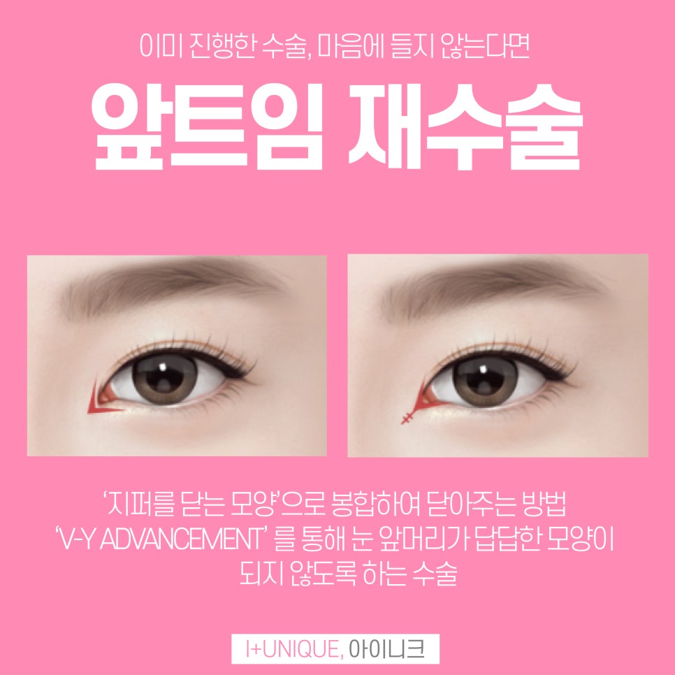 앞트임성형외과 더 이상 힘들게 알아보지 말고 아이니크로! 관련 이미지 4