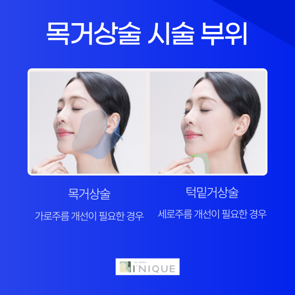 안면거상유명한곳 찾는다면 아이니크성형외과 관련 이미지 5