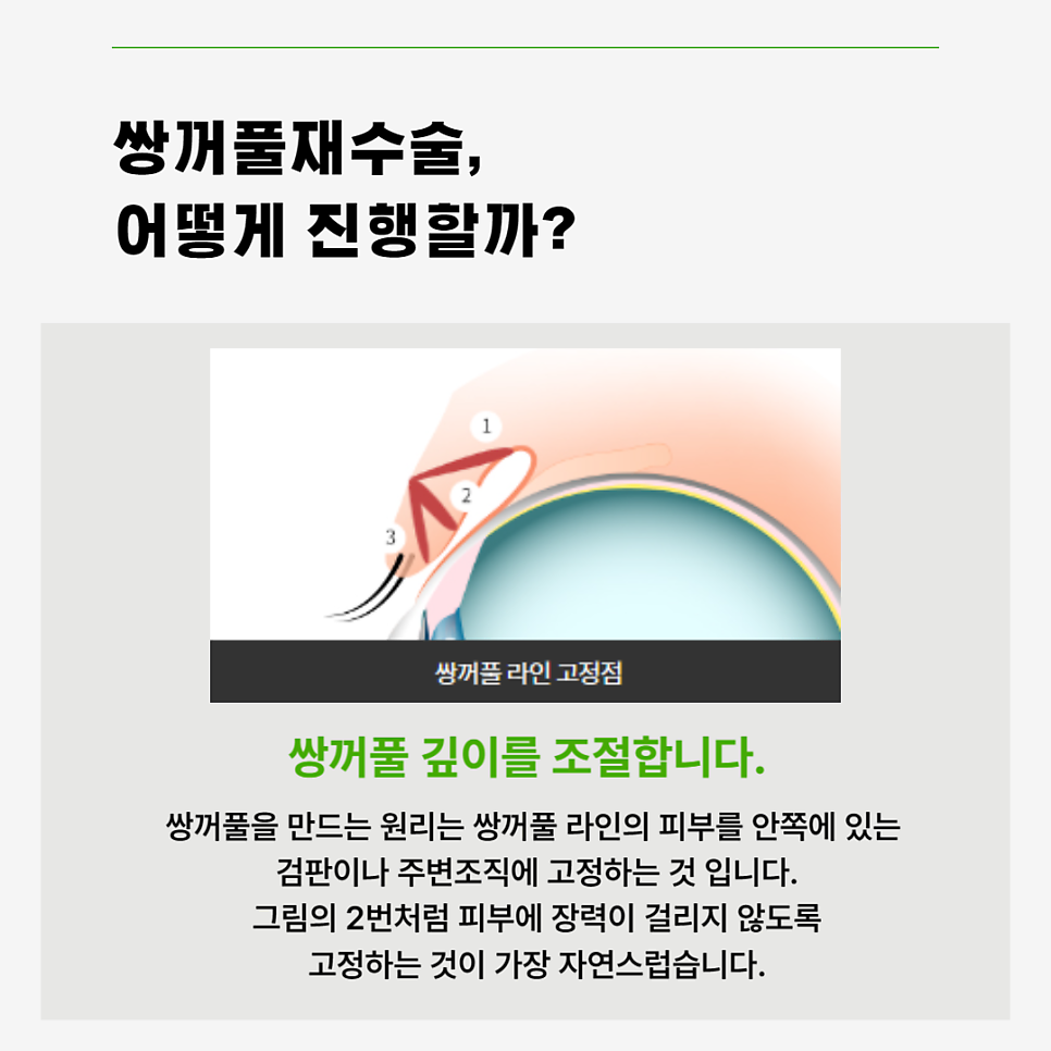 쌍수재수술병원 마지막수술이 되도록 관련 이미지 5