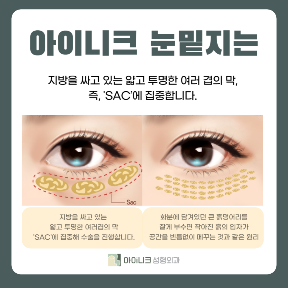 압구정눈밑지방재배치 새로운 수술법 관련 이미지 4